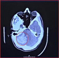 An MRI taken during the stroke revealed a large blood clot, highlighted in red.